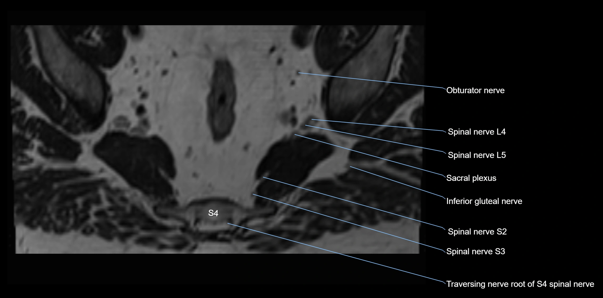 MR lumbosacral plexus axial cross sectional anatomy 3T  radiology  image-img-1008001-00098.webp